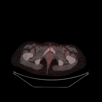 Cerebral and abdominal tuberculosis (Radiopaedia 90499-107853 C 244).jpg