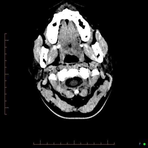 Cerebral arteriovenous malformation (AVM) (Radiopaedia 78162-90706 Axial non-contrast 2).jpg