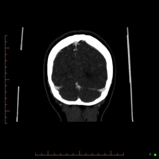 Cerebral arteriovenous malformation (AVM) (Radiopaedia 78162-90706 Coronal CTA 17).jpg