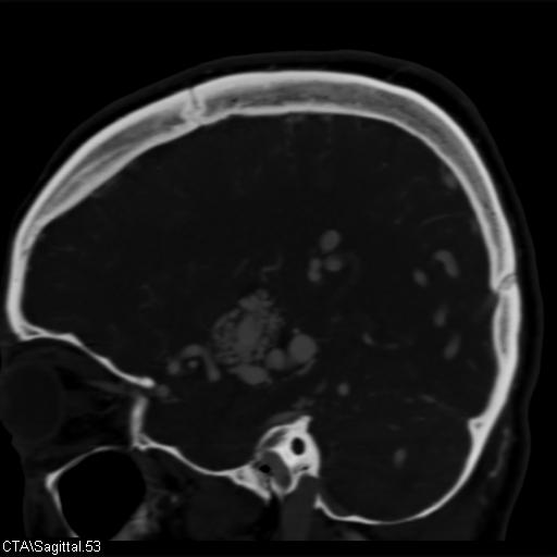 Cerebral arteriovenous malformation (Radiopaedia 28518-28759 D 50).jpg
