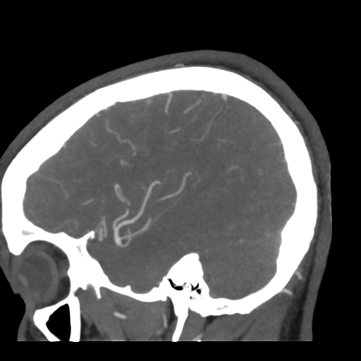 Cerebral arteriovenous malformation (Radiopaedia 39259-41505 Sagittal 16).png