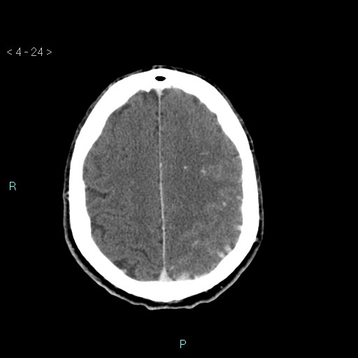 File:Cerebral arteriovenous malformation (Radiopaedia 40528-43125 Axial C+ delayed 24).jpg