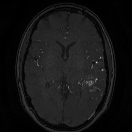 Cerebral arteriovenous malformation (Radiopaedia 74411-85654 Axial MRA 75).jpg