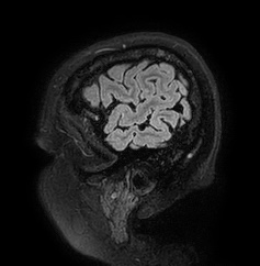 Cerebral arteriovenous malformation (Radiopaedia 74411-85654 Sagittal FLAIR 10).jpg