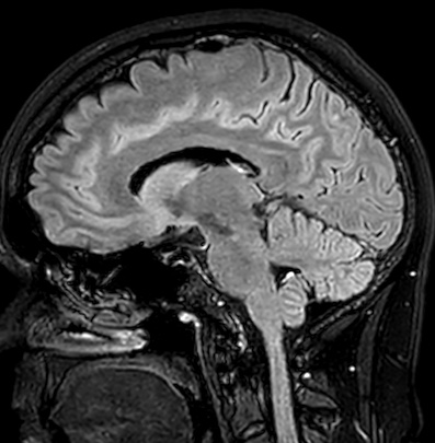 Cerebral arteriovenous malformation (Radiopaedia 74411-85746 Sagittal FLAIR 50).jpg