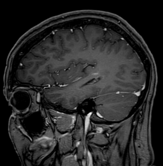 Cerebral arteriovenous malformation (Radiopaedia 74411-85746 Sagittal T1 C+ 30).jpg