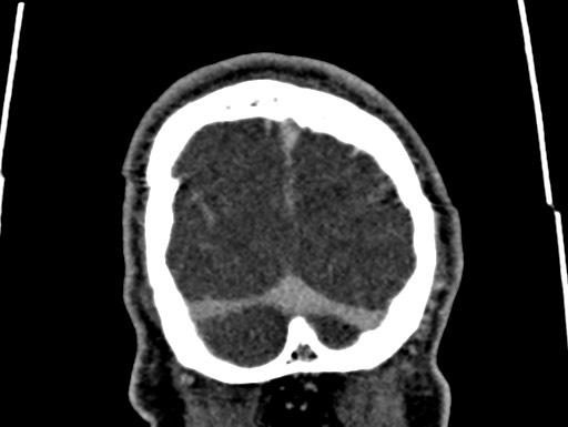 Cerebral arteriovenous malformation (Radiopaedia 78188-90746 Coronal C+ delayed 118).jpg