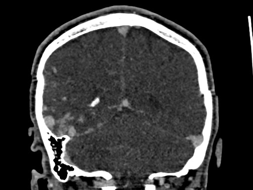 Cerebral arteriovenous malformation (Radiopaedia 78188-90746 Coronal C+ delayed 88).jpg