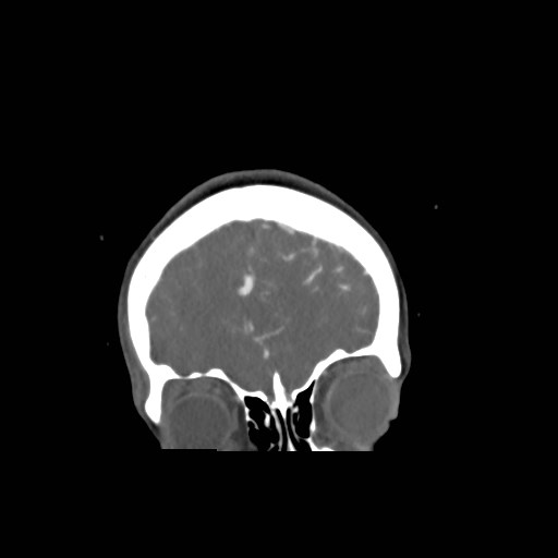 File:Cerebral arteriovenous malformation (Radiopaedia 79677-92888 B 3).jpg