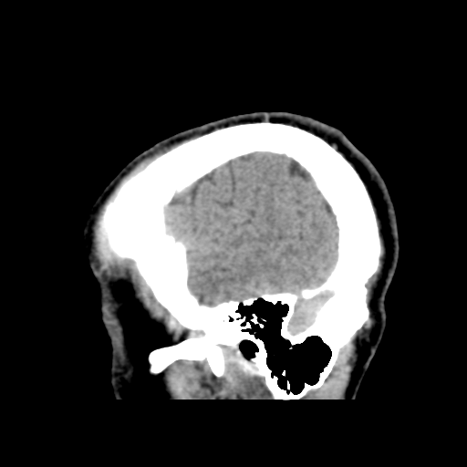 File:Cerebral arteriovenous malformation (Spetzler-Martin grade 2) (Radiopaedia 41262-44076 A 13).png
