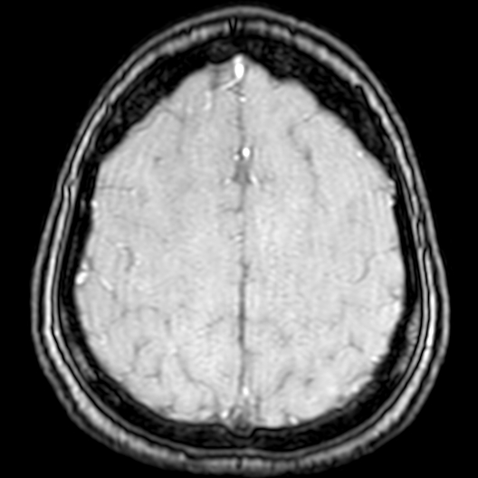 Cerebral arteriovenous malformation at posterior body of corpus callosum (Radiopaedia 74111-84925 Axial MRA 183).jpg