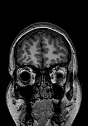Cerebral arteriovenous malformation at posterior body of corpus callosum (Radiopaedia 74111-84925 Coronal T1 27).jpg