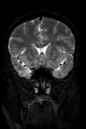 Cerebral arteriovenous malformation at posterior body of corpus callosum (Radiopaedia 74111-84925 Coronal T2 59).jpg