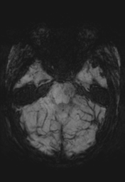 File:Cerebral cavernoma and development venous anomaly (Radiopaedia 37603-39482 Axial SWI MIP 11).png
