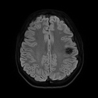 File:Cerebral cavernous venous malformation (Radiopaedia 70008-80021 Axial DWI 52).jpg