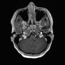 Cerebral cavernous venous malformation (Radiopaedia 70008-80021 Axial T1 C+ 10).jpg