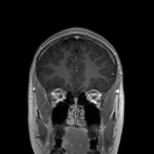 Cerebral cavernous venous malformation (Radiopaedia 70008-80021 Coronal T1 C+ 48).jpg