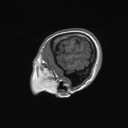 File:Cerebral cavernous venous malformation (Radiopaedia 70008-80021 Sagittal T1 7).jpg
