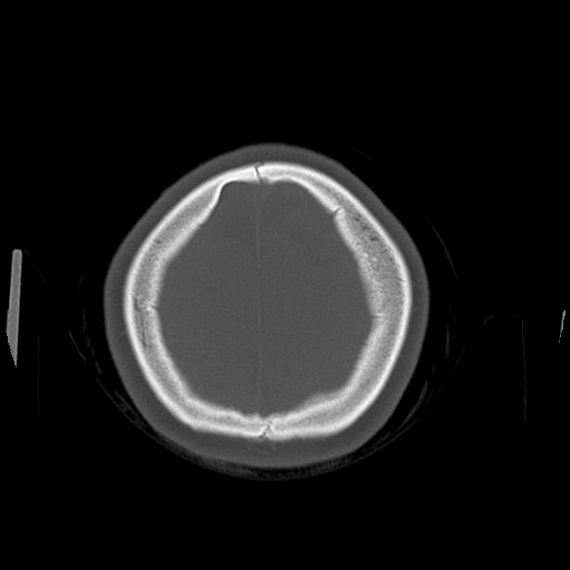 Cerebral cavernous venous malformation (Radiopaedia 70008-80022 Axial bone window 49).jpg