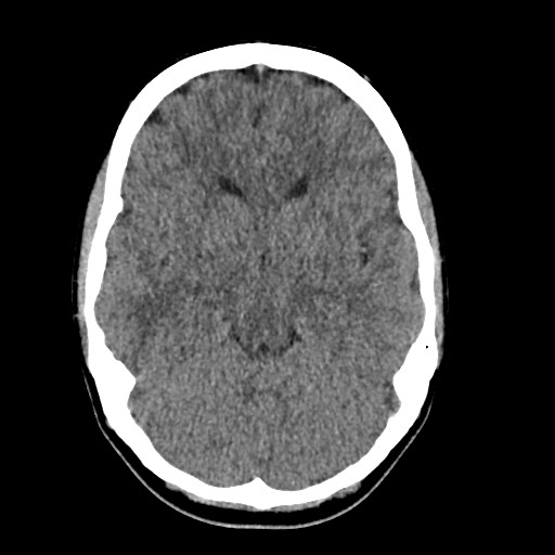 Cerebral cavernous venous malformation (Radiopaedia 70008-80022 Axial non-contrast 19).jpg
