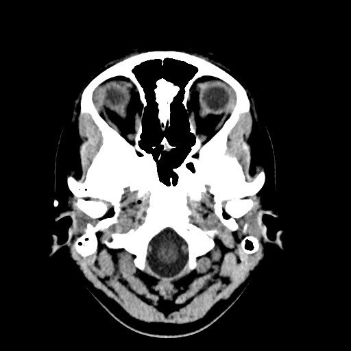Cerebral cavernous venous malformation (Radiopaedia 70008-80022 Axial non-contrast 3).jpg