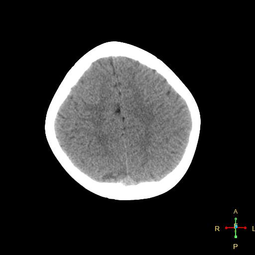 File:Cerebral contusion (Radiopaedia 48869-53911 Axial non-contrast 15).jpg