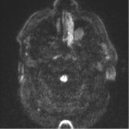 Cerebral embolic infarcts (embolic shower) (Radiopaedia 57395-64342 Axial DWI 38).png