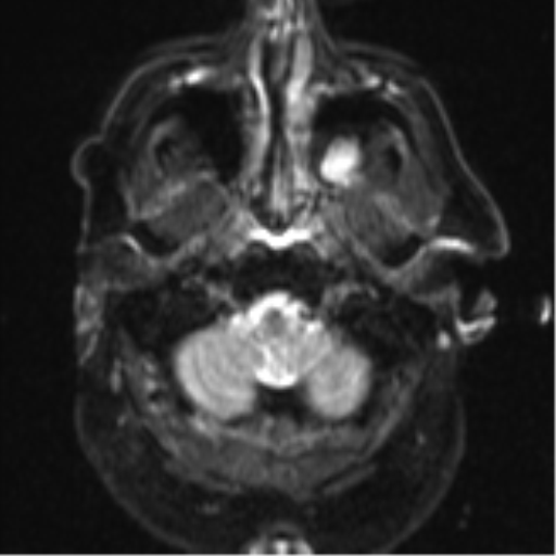 File:Cerebral embolic infarcts (embolic shower) (Radiopaedia 57395-64342 Axial DWI 4).png