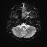 Cerebral embolic infarcts (embolic shower) (Radiopaedia 72391-82921 Axial DWI 5).jpg