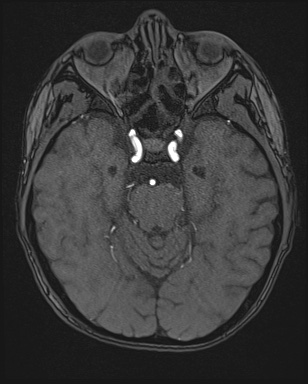 File:Cerebral embolic infarcts (embolic shower) (Radiopaedia 72391-82921 Axial MRA 51).jpg