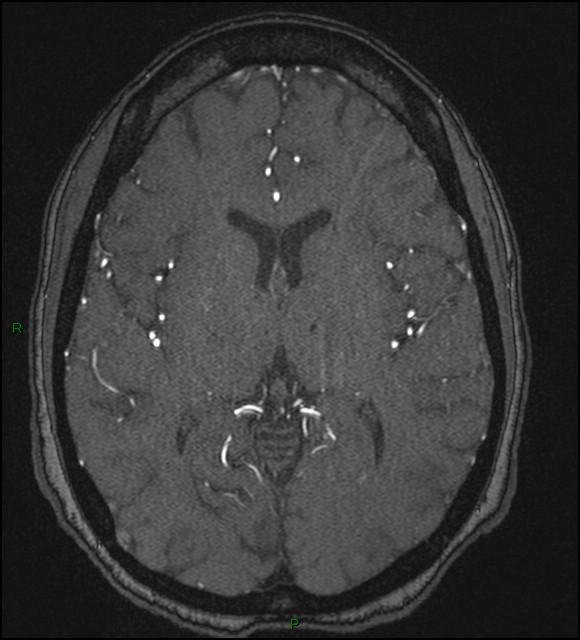 Cerebral fat embolism (Radiopaedia 35022-36525 Axial TOF 109).jpg