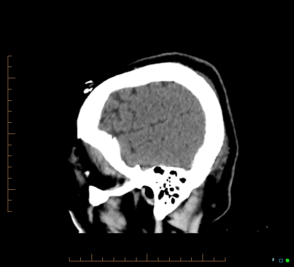 Cerebral fat embolism (Radiopaedia 85521-101220 B 9).jpg