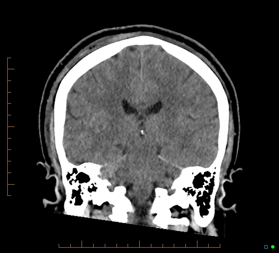 Cerebral fat embolism (Radiopaedia 85521-101224 Coronal non-contrast 38).jpg