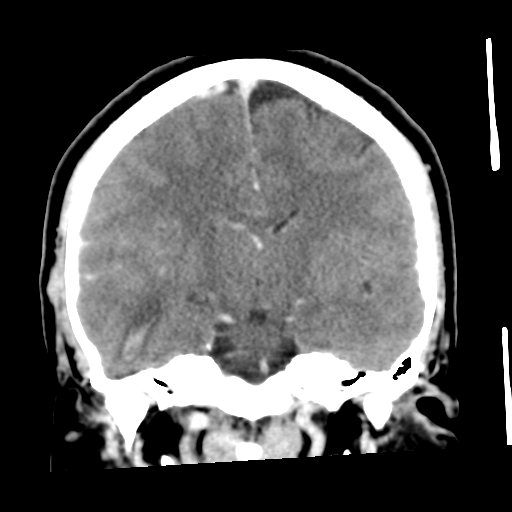 Cerebral hemorrhage secondary to arteriovenous malformation (Radiopaedia 33497-34561 C 34).png