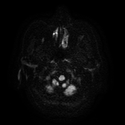 Cerebral metastases - melanoma (Radiopaedia 80972-94522 Axial DWI 36).jpg