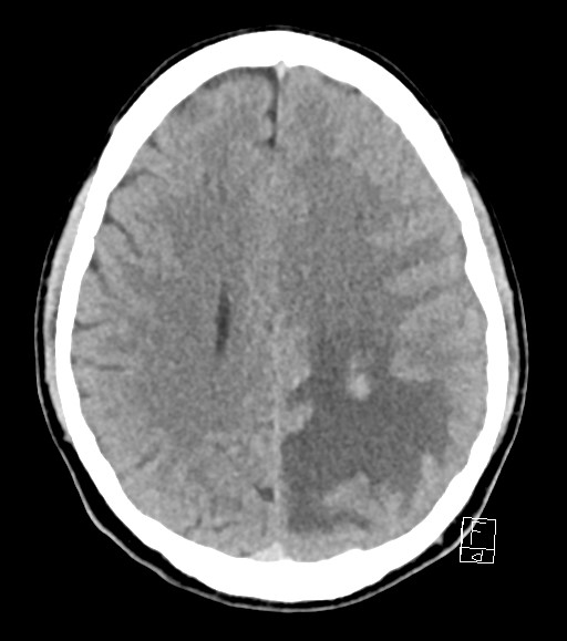 Cerebral metastases - testicular choriocarcinoma (Radiopaedia 84486-99855 Axial non-contrast 22).jpg