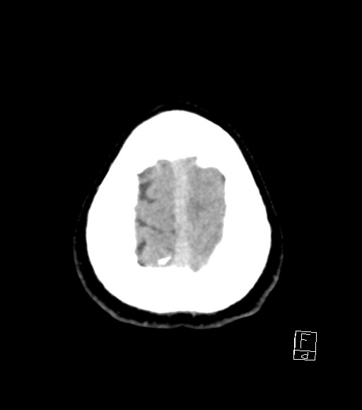 Cerebral metastases - testicular choriocarcinoma (Radiopaedia 84486-99855 Axial non-contrast 8).jpg