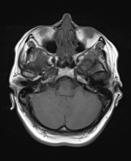 File:Cerebral metastases mimicking abscesses (Radiopaedia 45841-50131 Axial T1 7).png