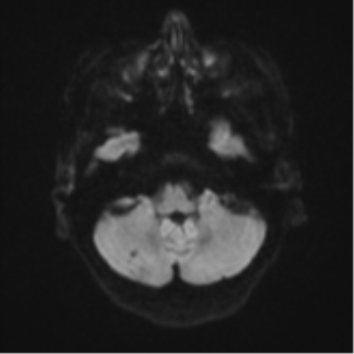 File:Cerebral metastasis (Radiopaedia 46744-51248 Axial DWI 34).png