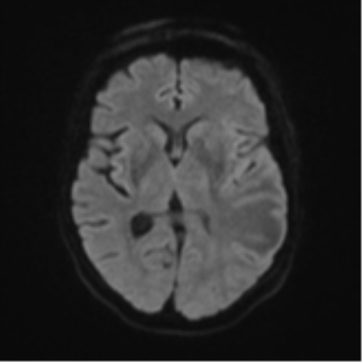 File:Cerebral metastasis (Radiopaedia 46744-51248 Axial DWI 42).png