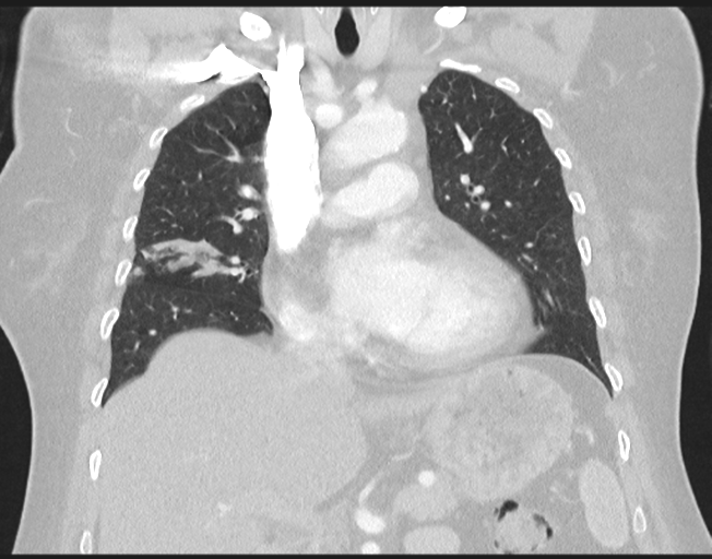 Cerebral metastasis to basal ganglia (Radiopaedia 81568-95414 Coronal lung window 39).png