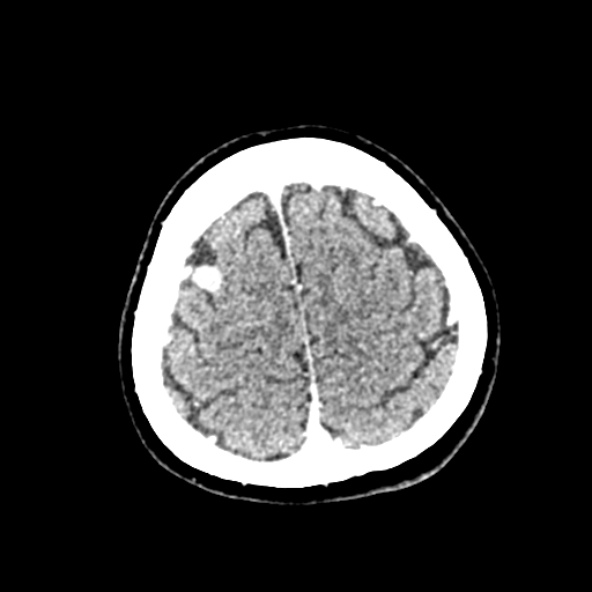 Cerebral ring enhancing lesions - cerebral metastases (Radiopaedia 44922-48818 B 243).jpg