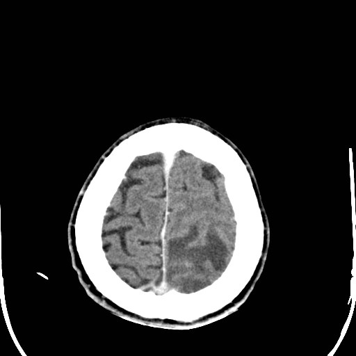 File:Cerebral toxoplasmosis (Radiopaedia 43956-47460 Axial C+ delayed 39).jpg