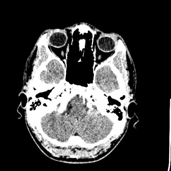 File:Cerebral toxoplasmosis (Radiopaedia 53993-60131 Axial C+ delayed 15).jpg