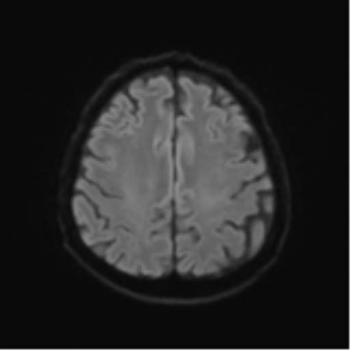 File:Cerebral toxoplasmosis (Radiopaedia 54575-60804 Axial DWI 56).png
