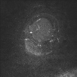 Cerebral tuberculosis with dural sinus invasion (Radiopaedia 60353-68090 Sagittal MRV 4).jpg