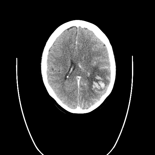 File:Cerebral venous hemorrhagic infarction (Radiopaedia 57576-64538 Sagittal C+ 1).png