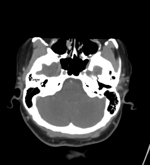 File:Cerebral venous infarction due to transverse sinus thrombosis (Radiopaedia 34688-36120 Axial CT venogram 13).png