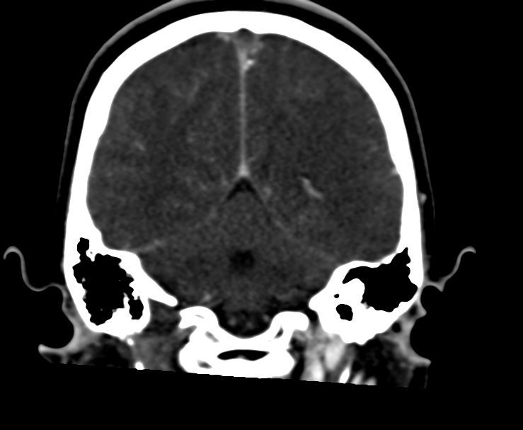 Cerebral venous sinus thrombosis (Radiopaedia 59224-66646 Coronal C+ delayed 52).jpg