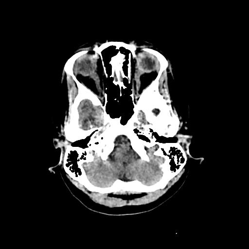 Cerebral venous throbmosis - hemorrhagic venous infarction (Radiopaedia 87318-103613 Axial non-contrast 29).jpg
